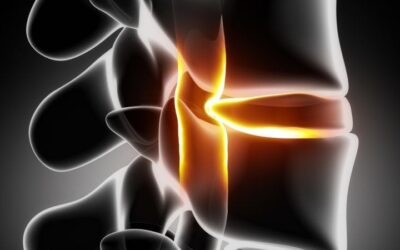 Combien de Temps Dure une Hernie Discale ? Tout Savoir