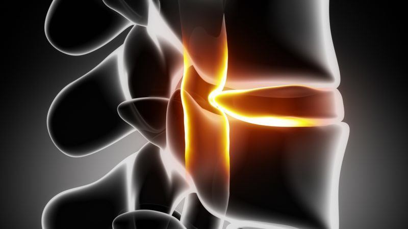 Combien de Temps Dure une Hernie Discale ? Tout Savoir